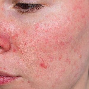 ร้านเจลรักษา Rosacea ผิวผื่นแดง หน้าแดงโรซาเซีย